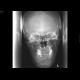 Fracture of facial skeleton, Le Fort III: X-ray - Plain radiograph